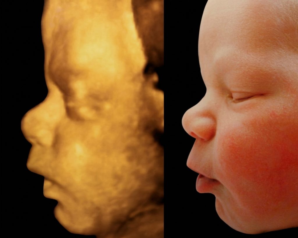 Comparaison d'un visage en échographie 3D et du même profil à la naissance